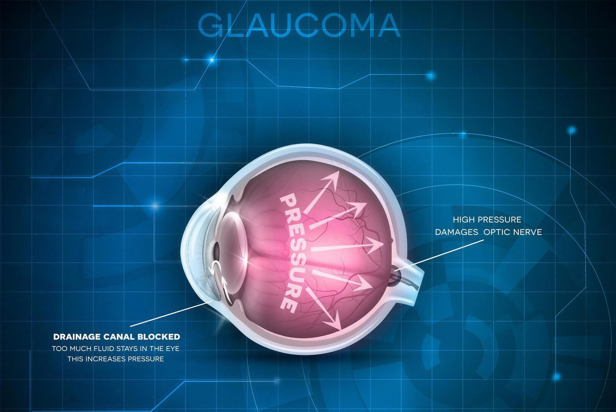 World Glaucoma Week