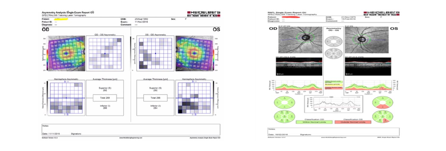 Visual field and OCT results used in glaucoma screening